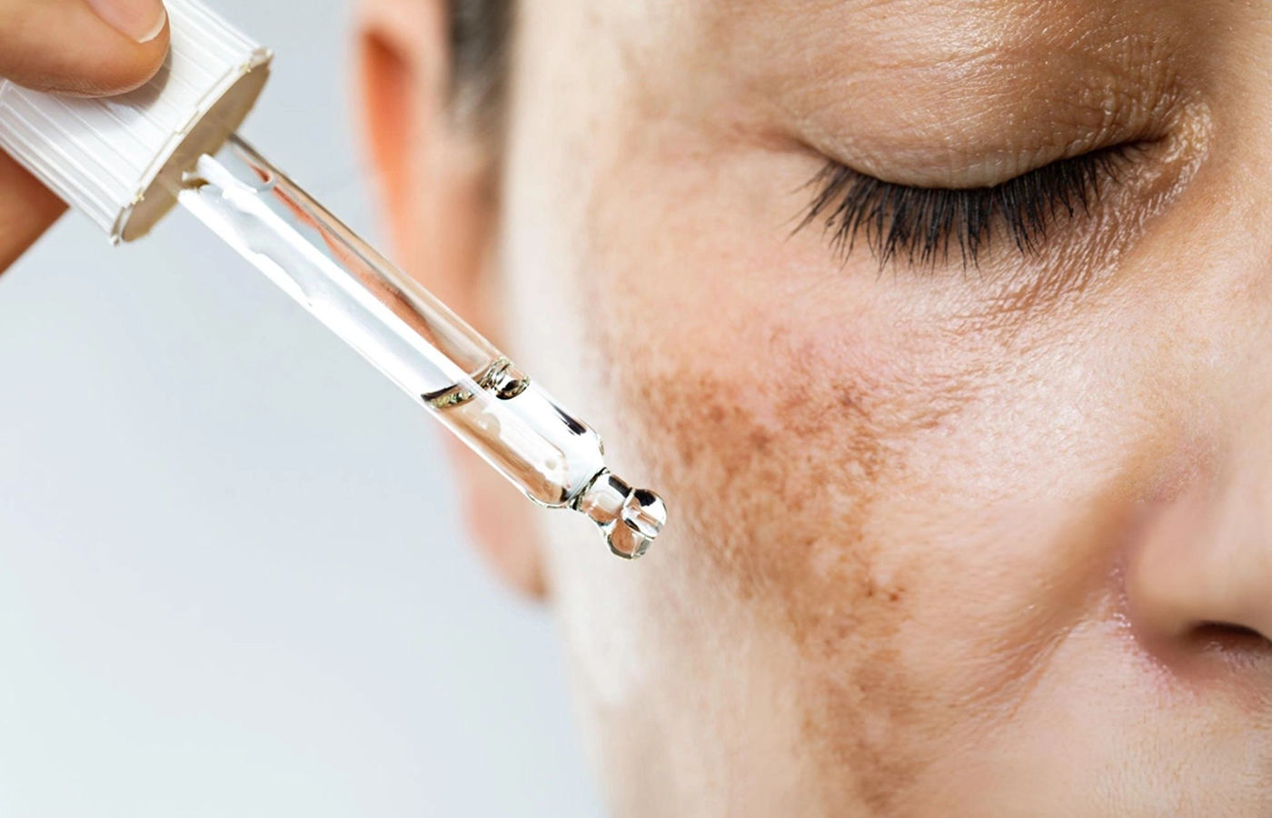 Close-up of a woman with even skin tone after melasma treatment at Dinaaz Hair & Skin Care Clinic