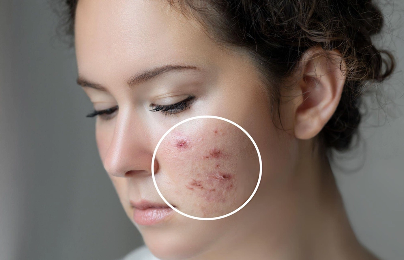 Before and after results of professional scar treatment at Dinaaz Hair & Skin Care Clinic
